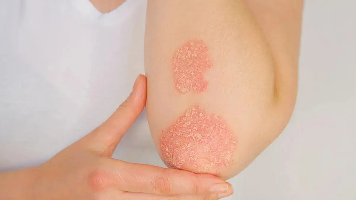 830-nm and 633-nm LED Light and Recalcitrant Psoriasis: What One Study Found